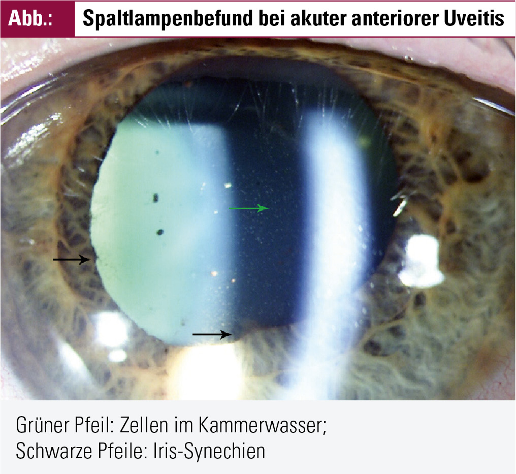 HLA-B27-positive Uveitis – Herausforderung für die Ophthalmologen ...